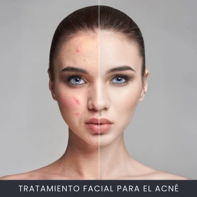 Tratamiento Facial Para el Acné