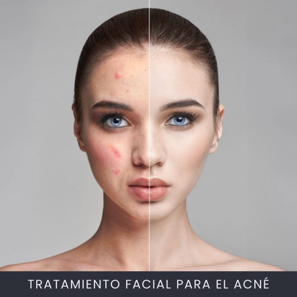 Tratamiento Facial Para el Acné