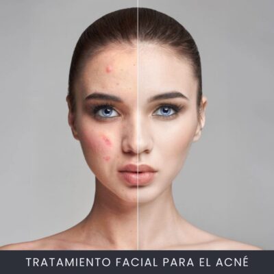 Tratamiento Facial Para el Acné