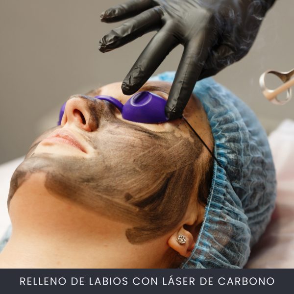 Tratamiento Facial Con Láser De Carbono Tratamiento Facial Con Láser De Carbono