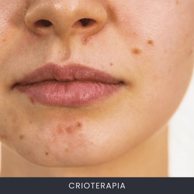Crioterapia