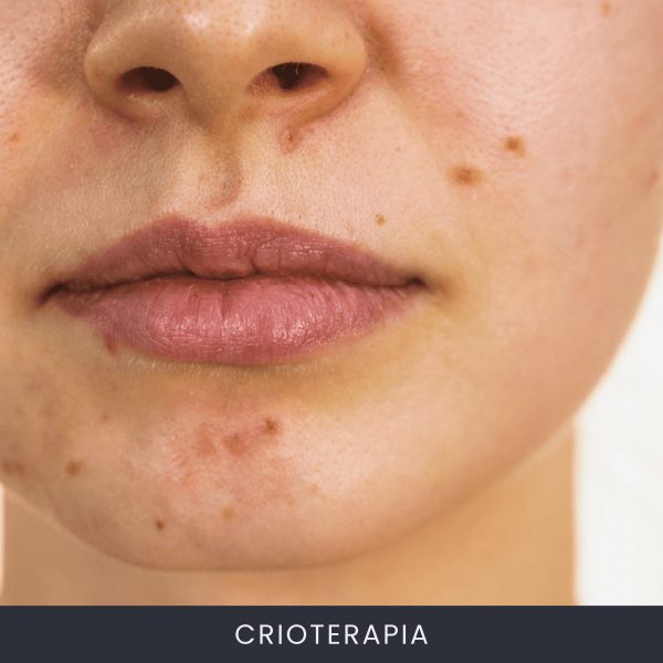 Crioterapia
