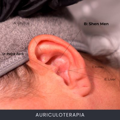 Auriculoterapia (Ear Seeding)