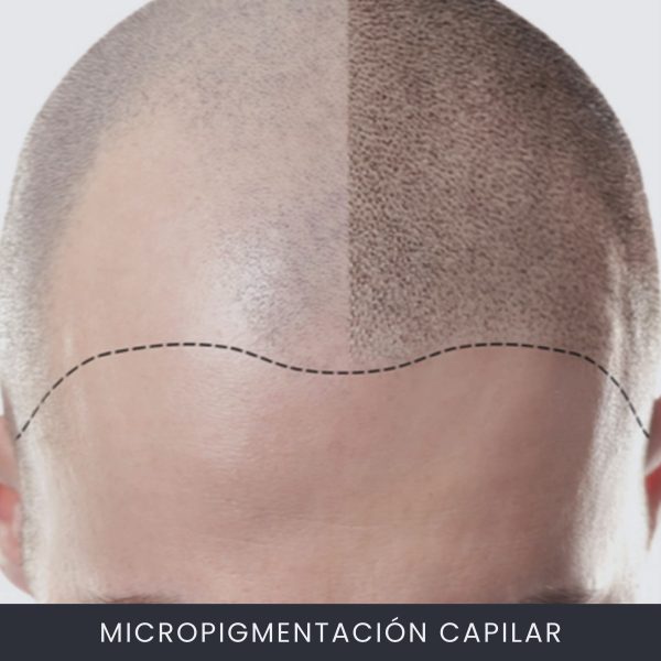 Micropigmentación Capilar