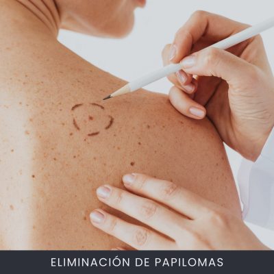 Eliminación De Papilomas