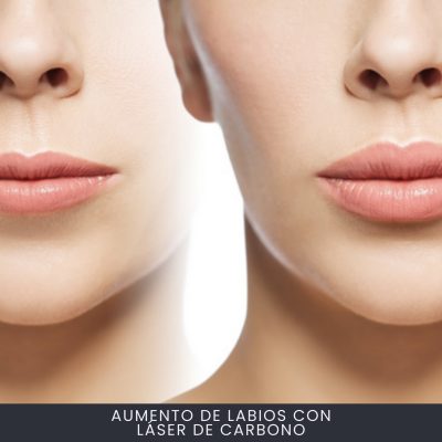 Aumento de Labios Con Láser De Carbono
