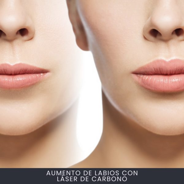 Aumento de Labios Con Láser De Carbono