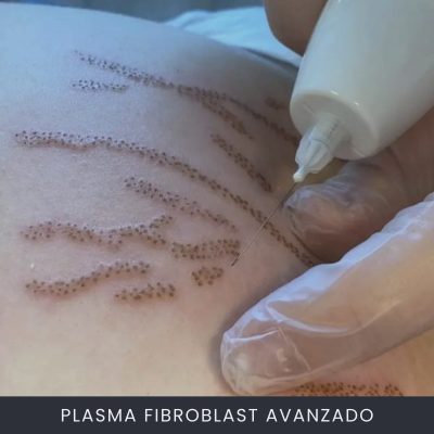 Plasma Fibroblast Avanzado
