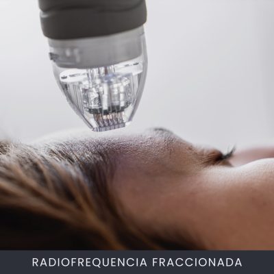 Radiofrequencia Fraccionada