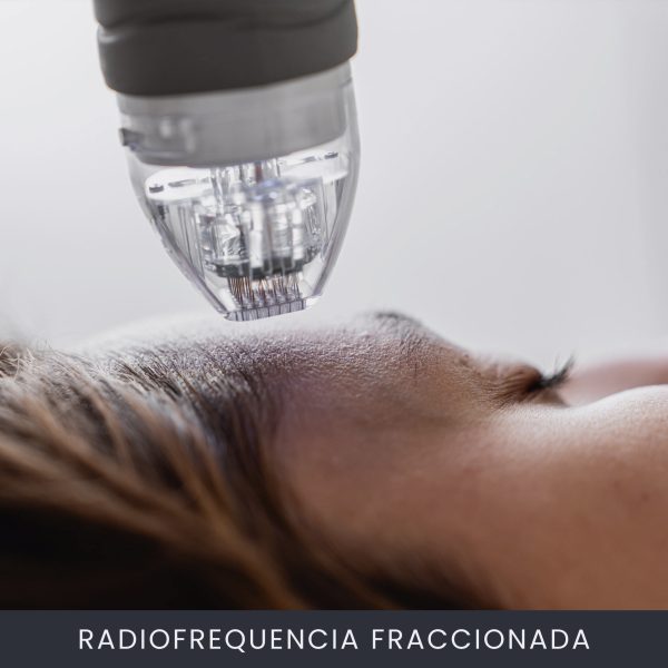 Radiofrequencia Fraccionada